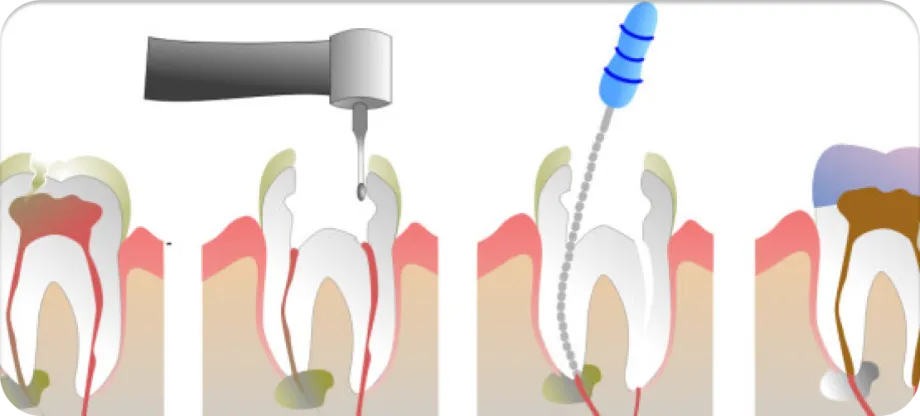 Endodontsko lijecenje - W